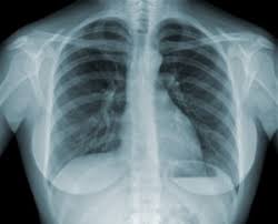 According to world health organization estimates, approximately 125 million people face workplace exposure to asbestos worldwide. Chicago Asbestos Mesothelioma Risks Attorney Abels Annes P C
