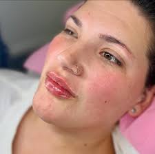 We loved how these lips turned out 😍😍😍 Want to start your lip filler  journey? Contact us via WhatsApp to book your appointments. +27 (082) 385  3320 **patient approved media release**