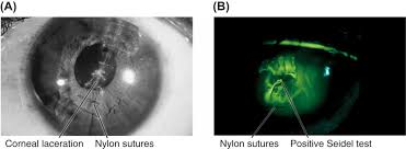 Image result for Seidel Test