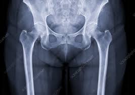 Image result for Hip XRay