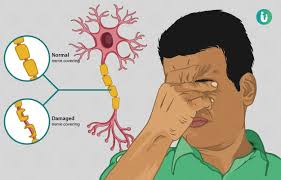 Multiple sclerosis (ms) is a neurodegenerative disease. Multiple Sclerosis Symptoms Causes Treatment Medicine Prevention Diagnosis