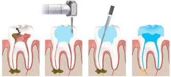 Care after the final visit of root canal treatment. Dead Tooth Signs Symptoms Causes Treatment Of Dead Tooth