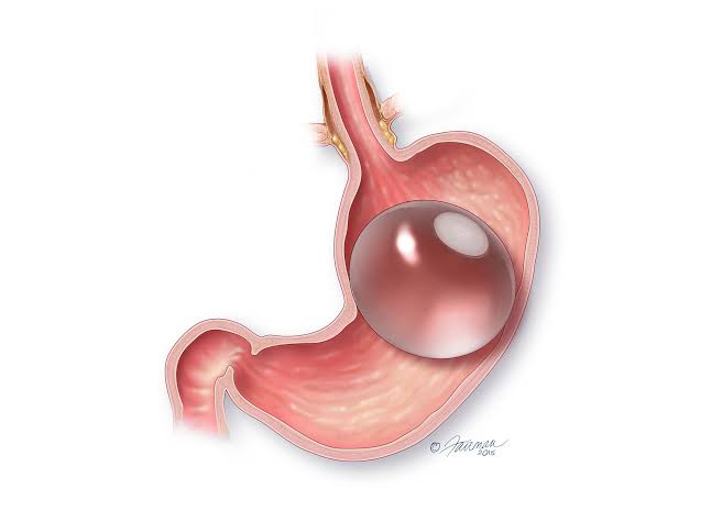 Orbera Balloon or Spatz3 Balloon: All about gastric balloons - The  Silhouette Clinic