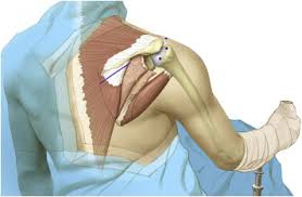 Apr 14, 2020 · the trapezius, commonly referred to as the traps, are responsible for pulling your shoulders up, as in shrugging, and pulling your shoulders back during scapular retraction. Outcome Of Arthroscopically Assisted Lower Trapezius Transfer To Reconstruct Massive Irreparable Posterior Superior Rotator Cuff Tears Journal Of Shoulder And Elbow Surgery