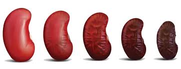 Pin On Curekidney Com
