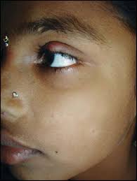 Tinea faciei is a superficial infection of the skin. Jaypeedigital Ebook Reader