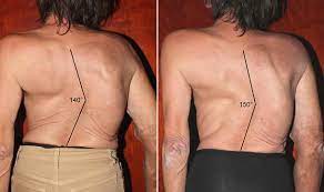 Correction Of Scoliosis In Adulthood Without Surgery