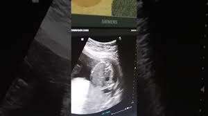 Gambar proses perkembangan pertumbuhan bayi janin dalam kandungan dan hasil usg 4d usia 14 minggu (3 bulan lebih) tulang dan sumsum tulang di dalam sistem kerangka terus berkembang. Usg Kandungan 5bulan Anak Perempuan Youtube