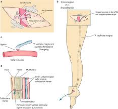 Pflasterstrips, wundnahtstreifen, klammerpflaster mit den abmessungen 102,0 x 6,4 mm. Varikose Der Unteren Extremitat Springerlink
