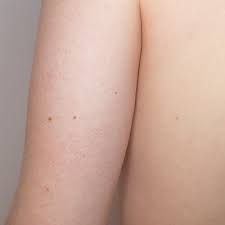 Image result for Keratosis pilaris