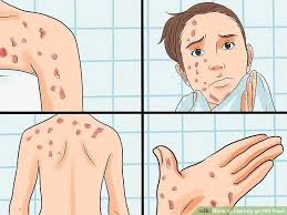 Image result for skin rash acute hiv infection
