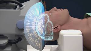 ¿en qué músculos puede afectar el temblor esencial? Nueva Tecnica No Invasiva Para Tratar El Temblor Esencial Y Del Parkinson As Com
