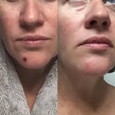 Sharing the LimeLight