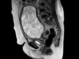 The cells that form gestational trophoblastic tumours are called trophoblasts and come from tissue that grows to form the placenta during pregnancy. Mri Is Indicated In Patients With Malignant Forms Of Gestational Trophoblastic Neoplasia Gtn For An Assessment Of Tumor Vasc Rings For Men Mri Representation