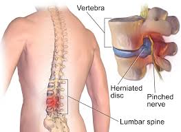 How many bones are in the human body? All About Spine Disc Problems