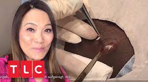 Dr pimple popper bursts huge 'tick' blackhead from ear in new video. Dr Sandra Lee Entfernt Zyste Mit Skalpell Dr Pimple Popper Tlc Deutschland Youtube