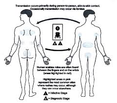 Image result for scabies transmission