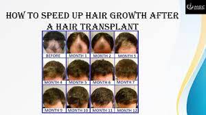 I love organic products, my friend introduce me to hair speed and i have fallen in love with these drops ever since. How To Speed Up Hair Growth After A Hair Transplant By Hairgrowth Centre Issuu