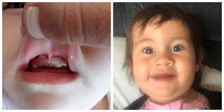 What causes abscess on gum? Toddler Waits Five Months For Treatment For Rotten Teeth Abscesses Rnz News
