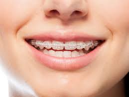 People having braces do sometimes have pain or discomfort in their mouths. Do Braces Hurt What To Expect When You Get Braces