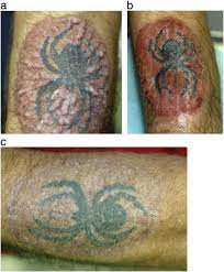 Many users even saw the comparison as completely off the mark. Tattoo And Vaccination Sites Possible Nest For Opportunistic Infections Tumors And Dysimmune Reactions Sciencedirect
