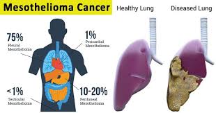 mesothelioma prognosis by cancer site. Mesothelioma Cancer Microbe Notes