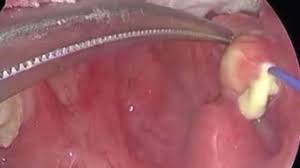 Schafft es das körpereigene immunsystem jedoch nicht, die viren und, oder die bakterien zu bekämpfen, sollte ein arzt aufgesucht werden. Arzt Entfernt Patientin Mandeln Und Macht Eklige Entdeckung Die Einem Den Magen Umdreht Gesundheit