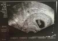 Endlich ist es so weit: Ultraschall 8 Ssw Ohne Anzeichen Forum Schwangerschaft Urbia De