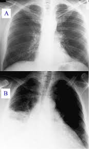 Image result for Pneumonia