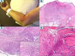 We did not find results for: Necrotizing Sweet Syndrome A New Variant Of Neutrophilic Dermatosis Mimicking Necrotizing Fasciitis Journal Of The American Academy Of Dermatology