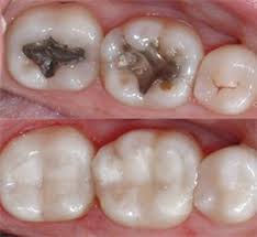 Corporate Wellness Is About Finding Fun Initiatives That Will Whip Your Office Up Into Shape Leaving You Fit Dental Fillings Tooth Colored Fillings Dentistry