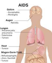 Aids Und Hiv Ihre Apotheke Informiert