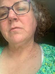 My husband has a rash