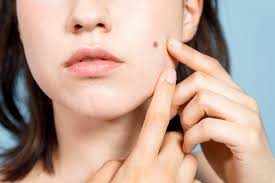 Find the latest laser procedures news articles, videos, blogs, books, continuing medical education (cme), meeting coverage, and journal articles. Acne Causes Treatments Merrimack Valley Laser Aesthetic
