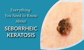 If you can catch them in their beginning stages, your dermatologist can formally evaluate. Seborrheic Keratosis 101 Everything You Need To Know Blog