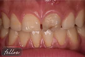 Image result for Tooth Discoloration