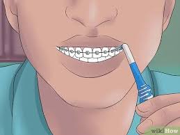 We did not find results for: 3 Ways To Clean Your Braces Wikihow Health