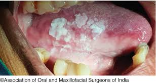 Image result for spinocellular carcinoma of the oral cavity