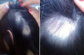 Sep 1, 2011 5:47:36 pm. Wen Hair Care Lawsuit See Photos Of Hair Loss People Com