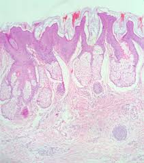 The lesion is usually congenital. Raquel Bittencourt On Twitter Skinsaturday Dermpath Nevus Sebaceous Of Jadassohn Not A Nevus Not Described By Jadassohn As A Professor Of Mine Would Say Https T Co Ydbk3bfbwn