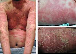Image result for Pustular Psoriasis