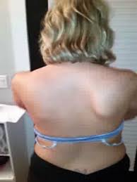 It is not that uncommon for them to stick out a bit. Leading The Way In The Treatment Of Scapula Winging
