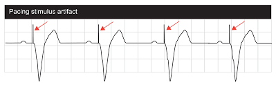 Atrial and ventricular pacing can be seen on the electrocardiogram (ecg) as a pacing stimulus (spike) followed by a p wave or qrs complex, respectively. Interpretation Of Pacemaker Ecg Ecg Echo