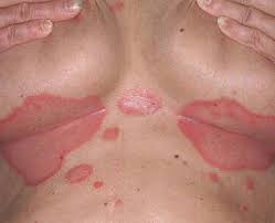 As these inflammatory breast cancer picture shows, the texture of the breast may change and appear to look dimpled or ridged, like an orange peel. 5 Signs Of Breast Cancer That Have Nothing To Do With Lumps Page 2 Of 5 Within Nigeria