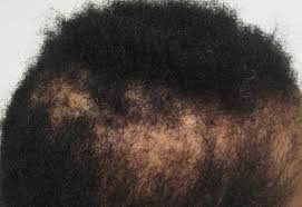 Afro Hair Loss Treatment For Black Hair Causes Of Thinning Hair