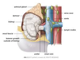 Kidney cancer stages 4 prognosis & survival rate. Kidney Cancer Patient Information