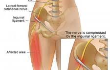 Image result for Pelvic Compression Test