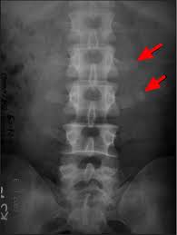 Transverse Fracture Transverse Process Fracture Causes Treatment