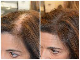 When it comes to fighting thinning hair, remember these two words: Instant Coverage Of Roots And Thinning Patches New Product Therapy Hair Studio
