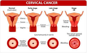 Early on, cervical cancer may not cause signs and symptoms. 7 Warning Symptoms Of Cervical Cancer That Every Women Should Know Uplinkgh News